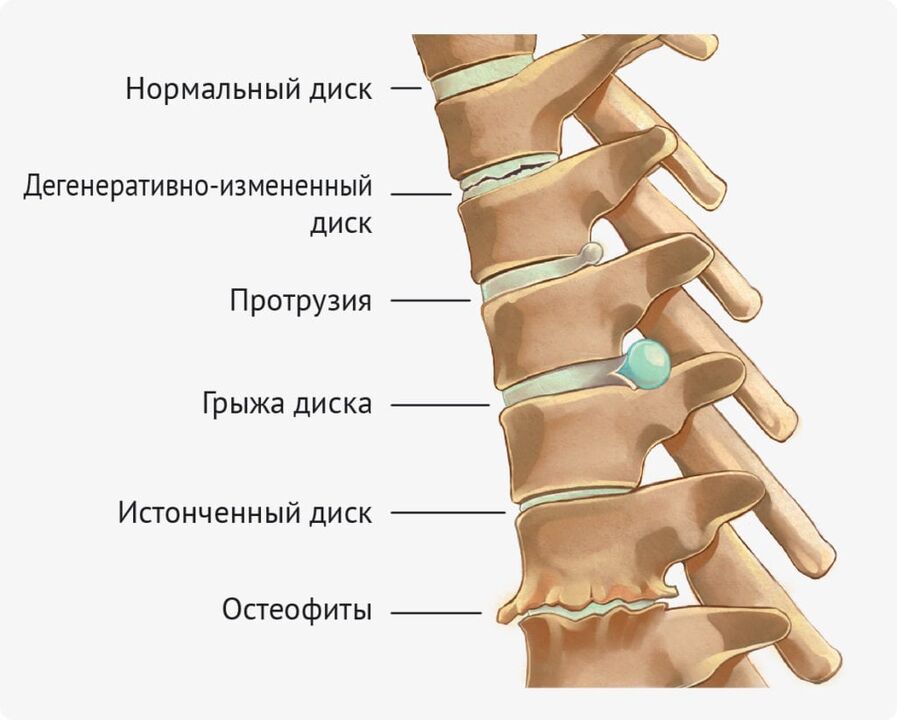 Deformidad del disco para osteocondosis lumbar