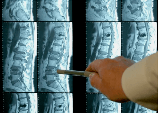 Variedad de osteocondrosis en la columna vertebral