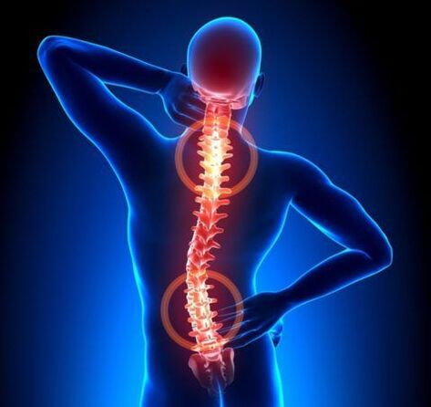 Osteocondrosis de la columna