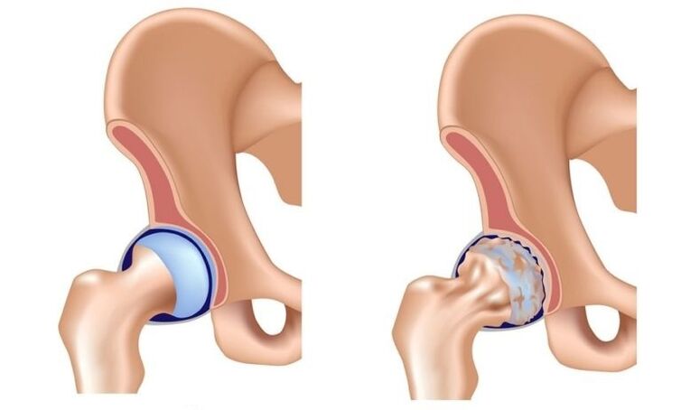 Articulación sana y articular con artrosis