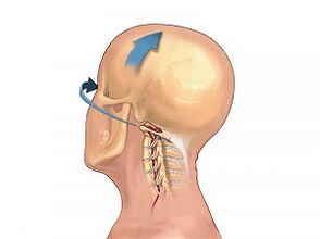 Cómo se manifiesta la osteocondosis de la columna cervical