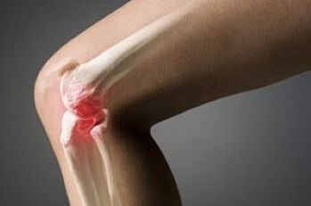La artrosis de la articulación de la rodilla es una lesión del tejido del cartílago