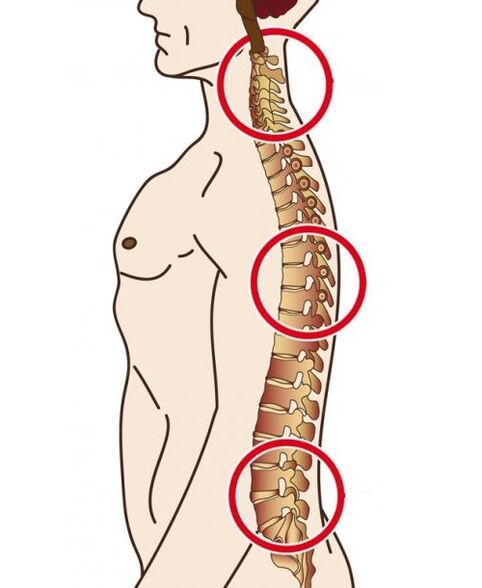 Departamentos de la columna en los que ocurre la osteocondosis