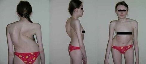 curvatura de la columna como consecuencia de la osteocondosis
