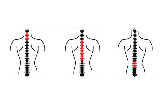 Cómo se manifiesta la osteocondrosis